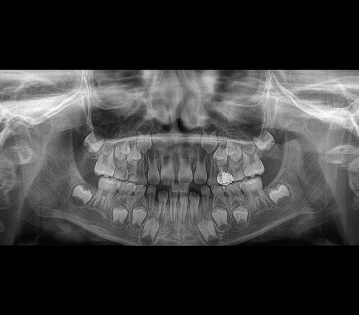 Genoray - Papaya 3D Plus (OPG) X-Ray Imaging System